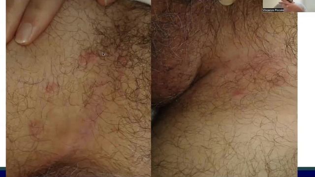 Common fungal infections in children | Dr Vincenzo Piccolo смотреть онлайн