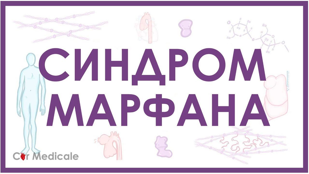 Синдром Марфана - механизм развития, причины, клинические проявления смотреть онлайн