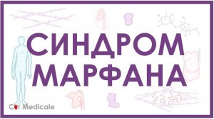 Синдром Марфана - механизм развития, причины, клинические проявления