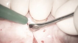 Резекция верхушки корня зуба