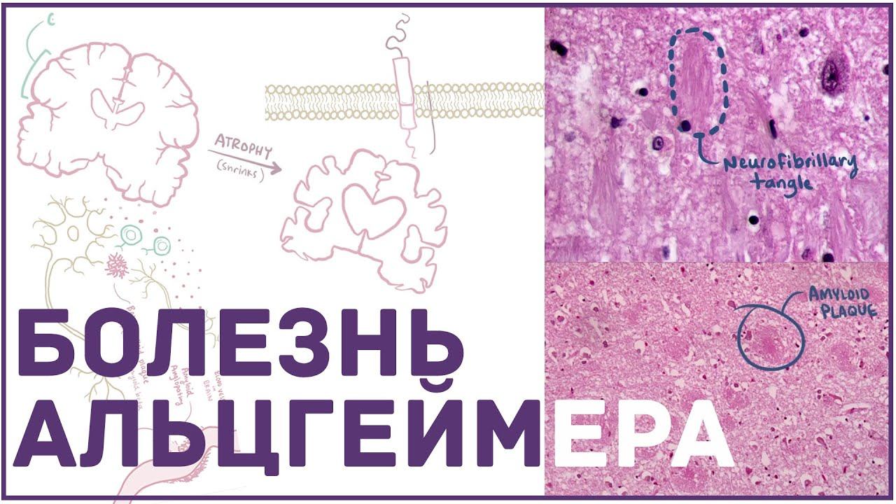 Болезнь Альцгеймера - причины, симптомы, патогенез, лечение смотреть онлайн
