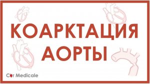 Коарктация аорты