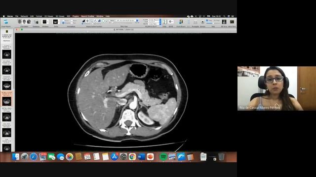 #6- Tomografia Computadorizada do Abdome: como eu avalio na prática смотреть онлайн