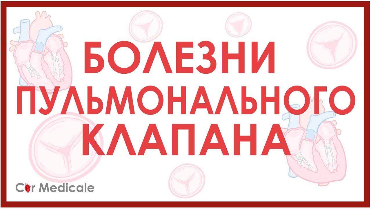 Болезни пульмонального клапана: стеноз и регургитация/недостаточность клапана. смотреть онлайн