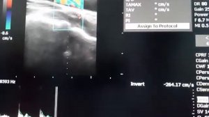 Пляска каротид при аортальной недостаточности