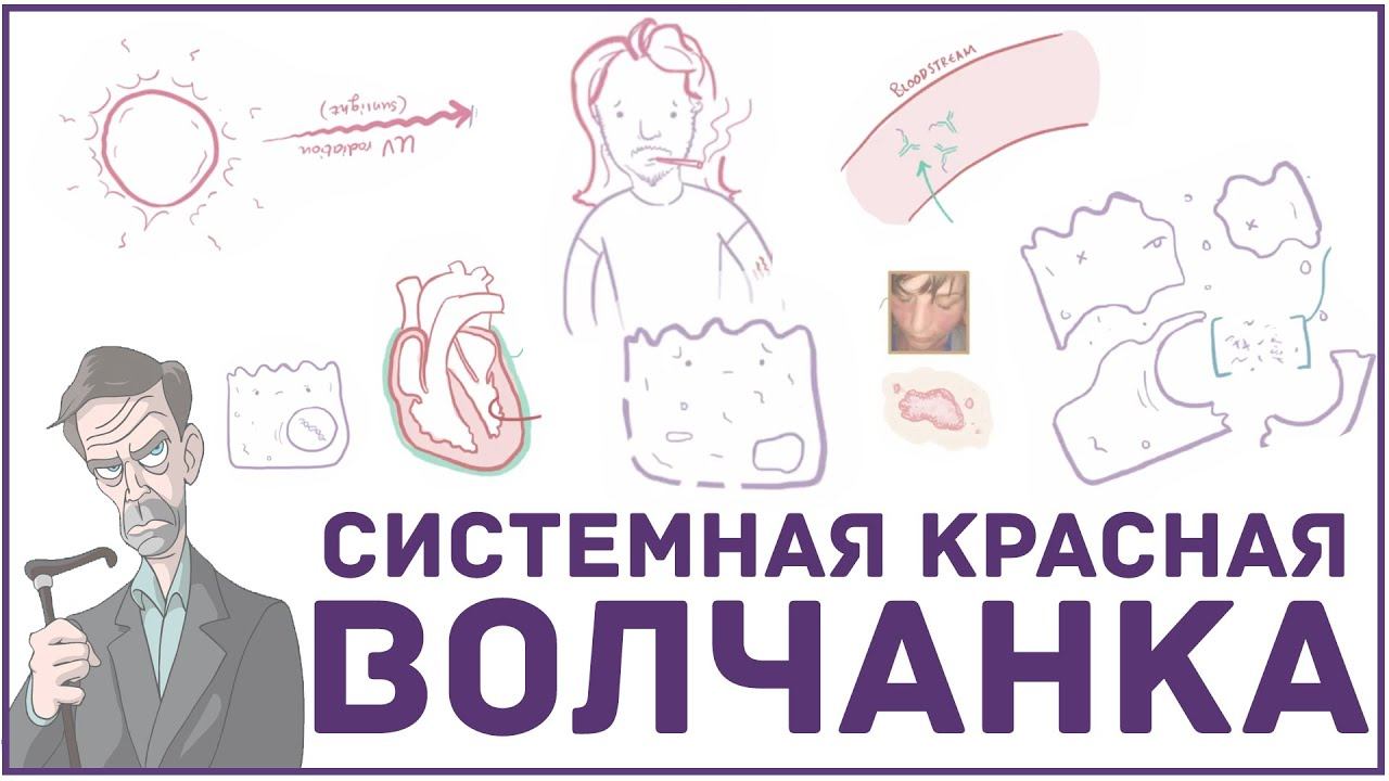 Системная красная волчанка - причины, симптомы, диагноз и патология смотреть онлайн