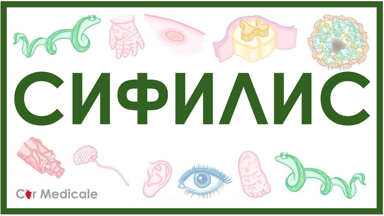 Сифилис - этиология, стадии, причины, симптомы, диагностика, лечение смотреть онлайн