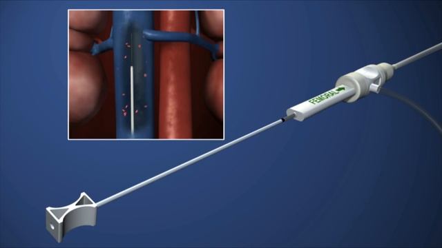 OptionELITE Retrievable Vena Cava Filter смотреть онлайн