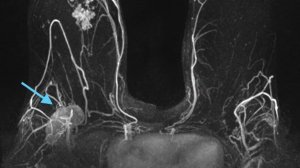 Для чего мы делаем МРТ молочных желез?