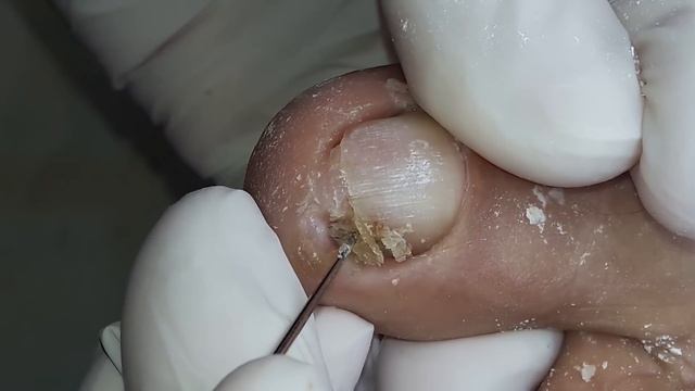 Uña encarnada | Onicocriptosis #podologiaintegral смотреть онлайн