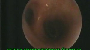 Фибробронхоскопия. Череповец. МСЧ "Северсталь".