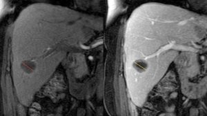 Система RECIST: как правильно оценить результат химиотерапии?