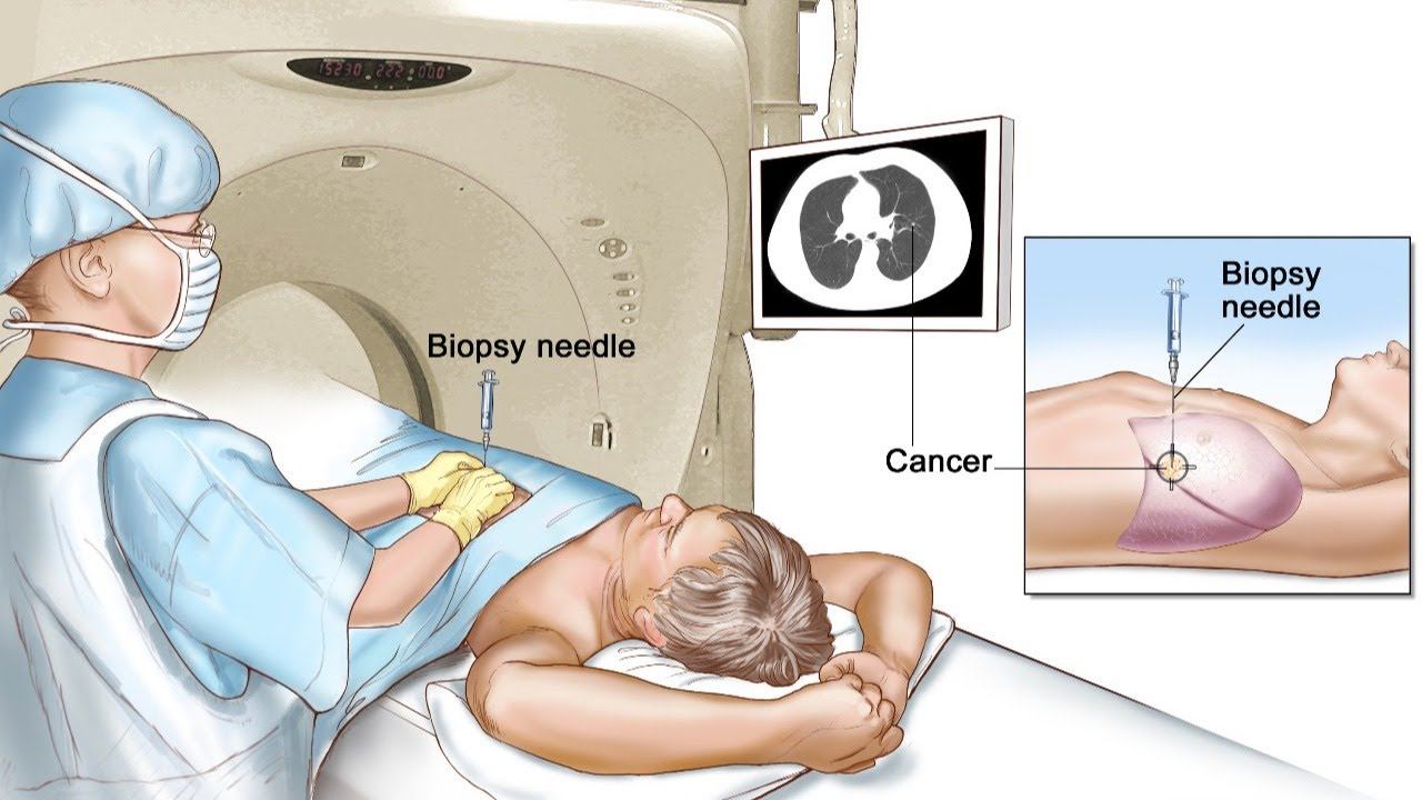 Биопсия под контролем КТ. Как мы это делаем?
