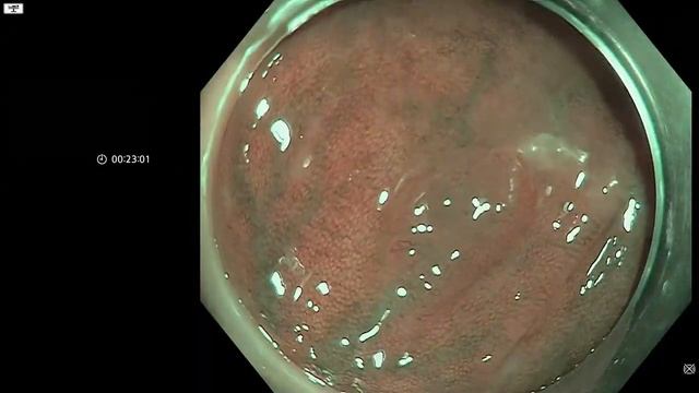 Diminutive Adenoma Detection with AI - Olympus ENDOAID Target Mode, NBI смотреть онлайн
