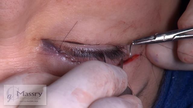 Watch Upper and Lower Blepharoplasty with Surgical Adjuncts | Dr. Guy Massry смотреть онлайн