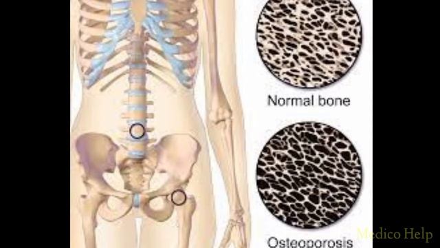 Alendronate Tablet | Medicine For Osteoporosis | Medicine For Paget's Disease | Alendronate Hindi