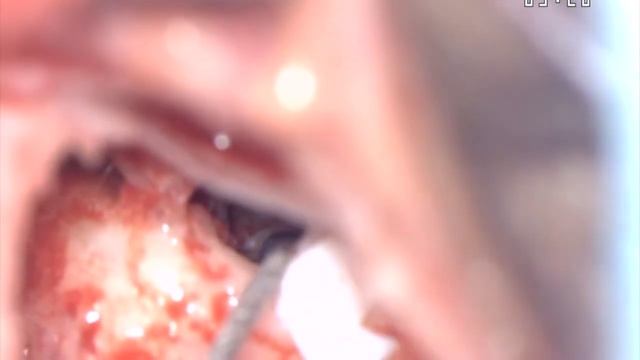 Cochlear implant Bilateral Advanced Bionics Hi Res ultra electrode смотреть онлайн