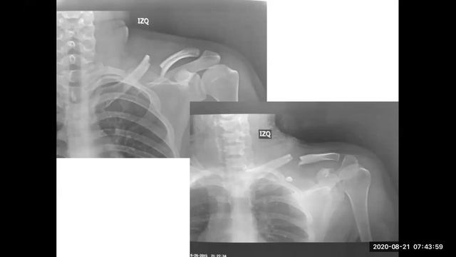 Fracturas De Clavicula  IDQP  Actividad Dr Camaro 21 Agosto 2020