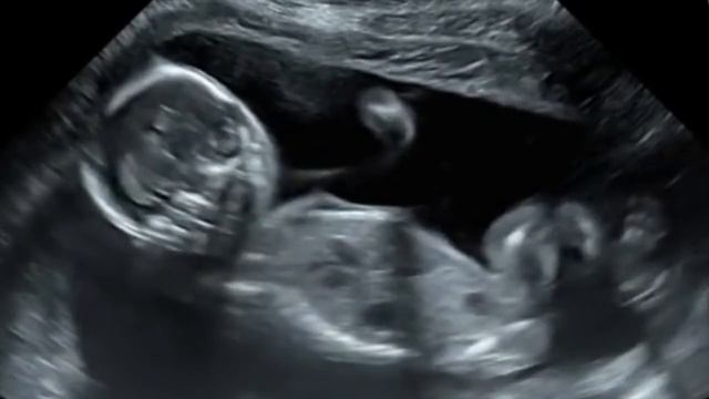 Аборт - это убийство! смотреть онлайн