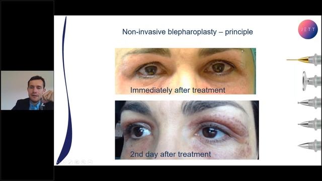 JETT PLASMA LIFT TANITIM DR. BARAN