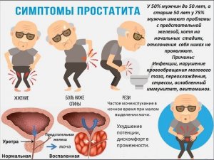 Истинные причины простатита и аденомы простаты
