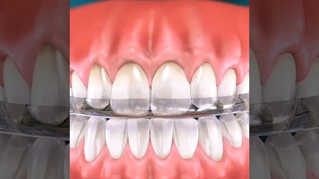Placa para Bruxismo dental (nocturna/diurna) смотреть онлайн