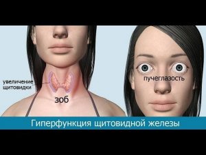 Истинные причины гипертиреоза.