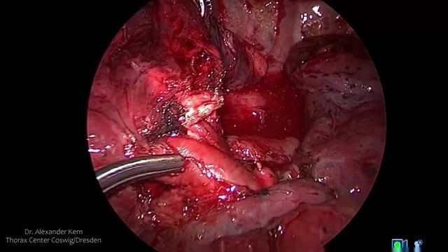 duoportal VATS anatomic right segmentectomy S6 with articulating instruments and ICG application смотреть онлайн