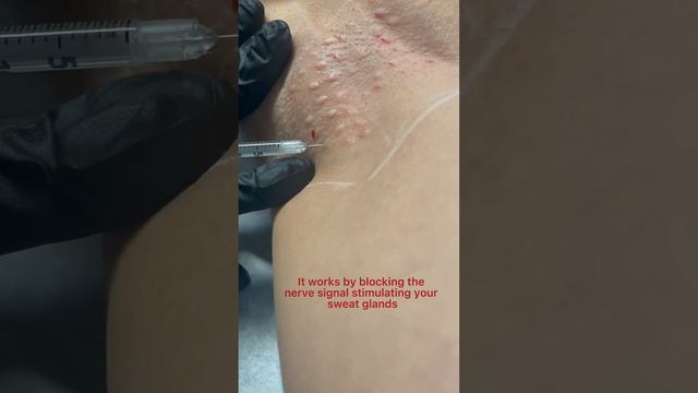 Botox For Sweating