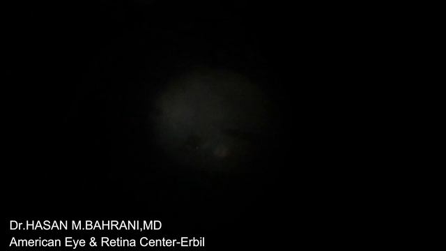 Very Large Traumatic Macular Hole Retinal Detachment Vitrectomy Dr Hasan Bahrani, MD смотреть онлайн