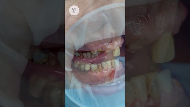 Планируем удалить 23 зуба. Спасти эти зубы уже нельзя. Имплантация зубов. смотреть онлайн
