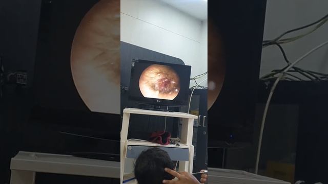 Exposed Temporomandibular Joint In External Auditory Canal - Dr Hitesh Patel