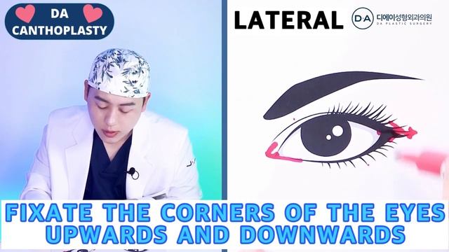 [Plastic Surgery in Korea] What is Canthoplasty? Should You Get Canthoplasty or Avoid Getting It? смотреть онлайн