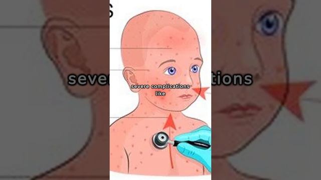 After measles case confirmed in Nassau, here are ways to protect your family. #Measles #Child смотреть онлайн