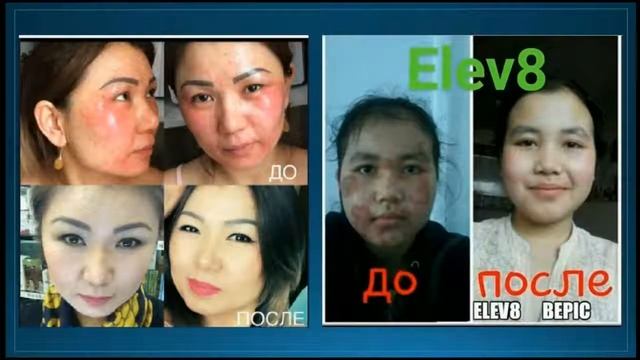 #ELEV8 ВИТИЛИГО И ПСОРЕАЗ ИЗЛЕЧИМЫ. смотреть онлайн