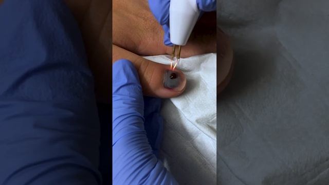 Trephination of a Fingernail Subungual Hematoma with Cautery смотреть онлайн