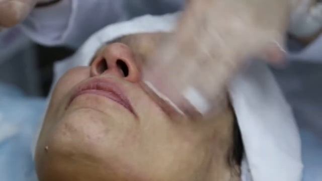 Фракционная мезотерапия аппаратом Dermapen Mesoderm смотреть онлайн