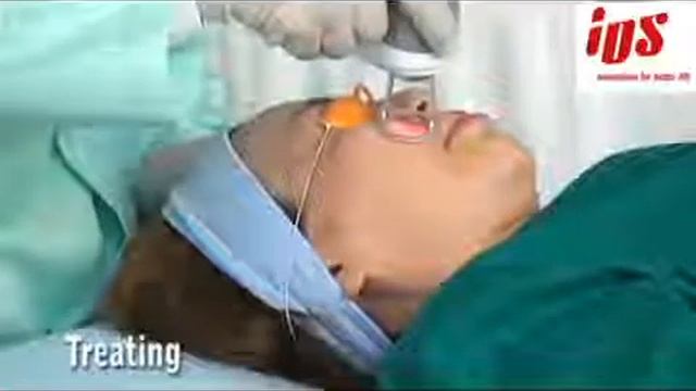 máy laser CO2 Fractional SMAXEL 0976999366 смотреть онлайн