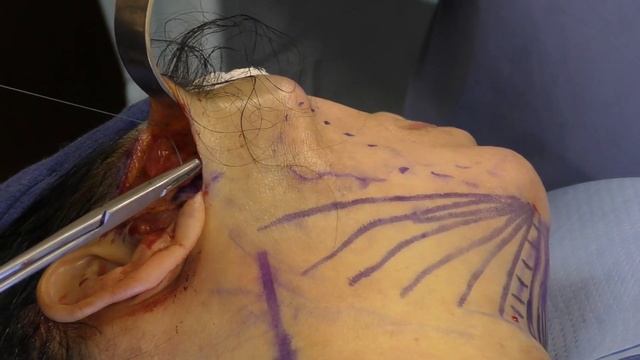 Mini Face Lift Performed By Dr. Mark Jabor смотреть онлайн