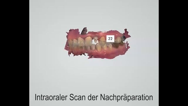 2018 2. Videopreis "Vollkeramische Versorgung auf wurzelanalogem Hybridimplantat" смотреть онлайн