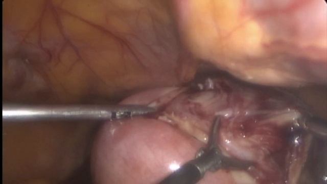 Laparoscopic myomectomy for 8cm fibroid by Dr Shrikant Khetmalas. смотреть онлайн