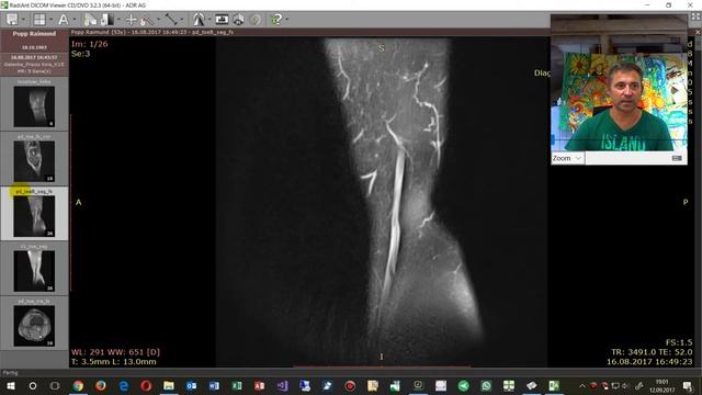 MRT Bilder auswerten mit Dicom Viewer. Entzündung im Knie смотреть онлайн