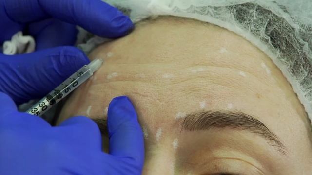 Техника инъекциий full-face ботулотоксина NEURONOX смотреть онлайн