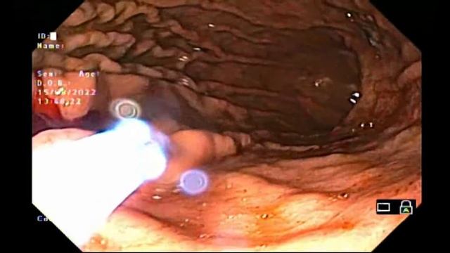 Endoscopic argon plasma coagulation in PHG in upper GI bleeding.#endoscopy #bleeding смотреть онлайн