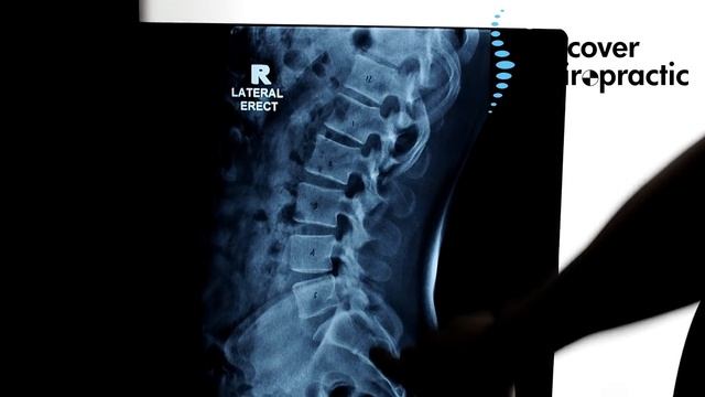 Spinal STENOSIS, L4 disc bulge with SCIATICA RESOLVED with Dr. Sean Gonstead Chiropractor смотреть онлайн