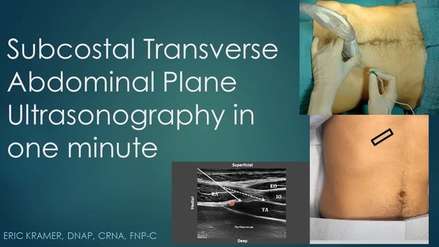 Subcostal TAP Block Ultrasonography in 1 Minute смотреть онлайн