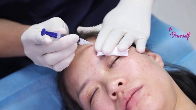 Trueself PLLA Dermal Filler 400 For Forehead