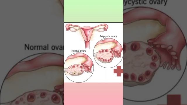 What Is PCOD/PCOS 🤔#pcod #pcos #pcostreatment