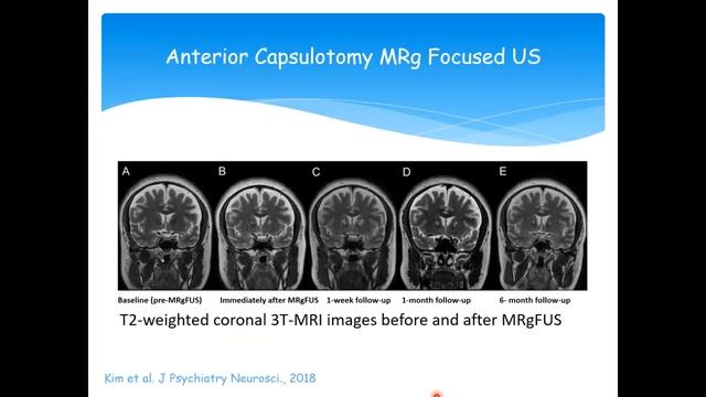 Webinar: Renana Eitan - Back to the Future: Focused Ultrasound for Psychiatric Disorders смотреть онлайн