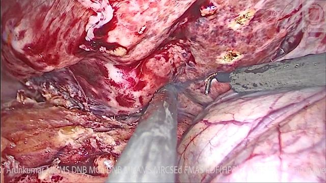 SEGMENT 6 LIVER RESECTION смотреть онлайн